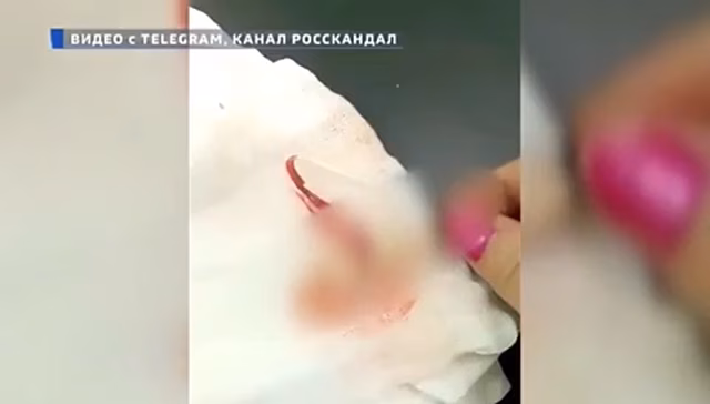 В Надыме санитарка поглумилась над оторванным пальцем пациентки