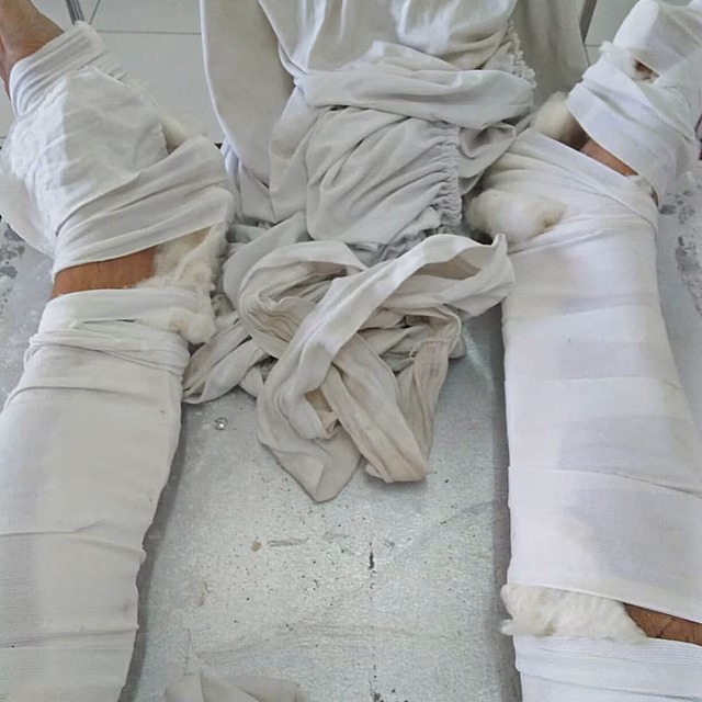 Во Вьетнаме житель Маркса попал в ДТП и сломал обе ноги