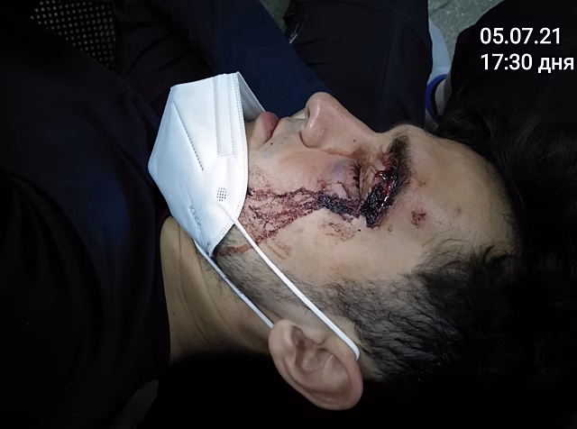 В Новосибирске водитель «Мерседеса» из-за царапины сломал глазницу доставщику еды