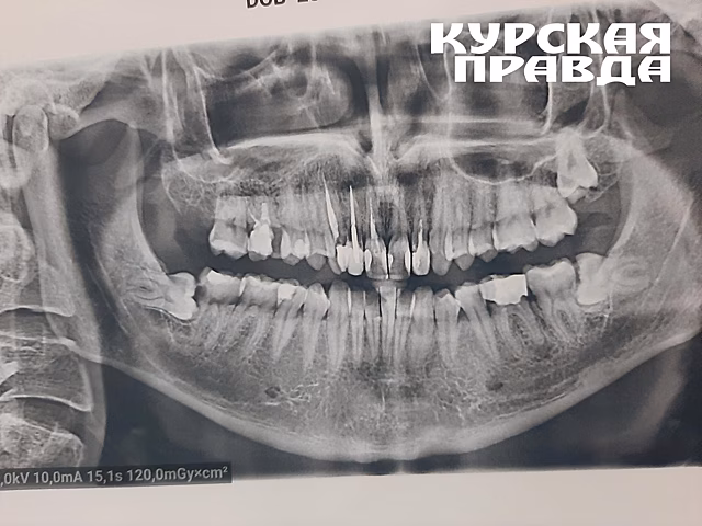 В Курске 26-летняя девушка выбила стеклянной бутылкой 4 зуба незнакомке